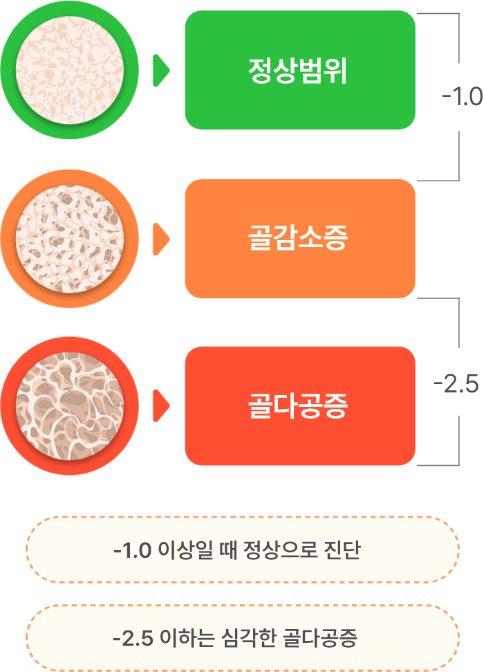 골밀도의 정상범위, 골감소증, 골다공증을 표현한 도식 그래프 이미지