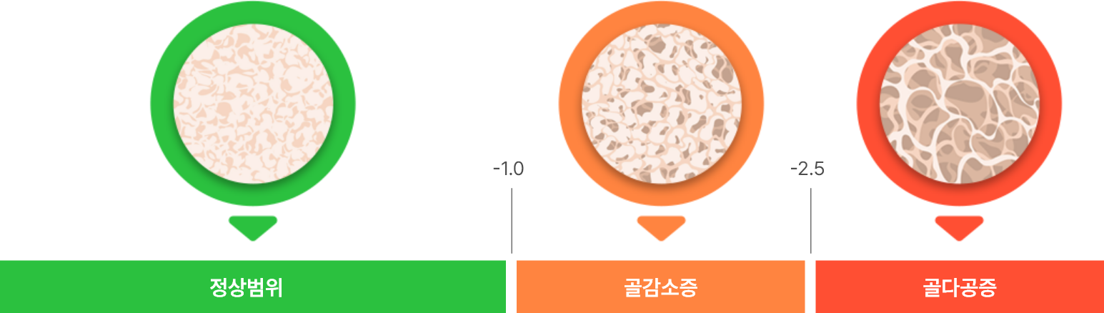 골밀도의 정상범위, 골감소증, 골다공증을 표현한 도식 그래프 이미지